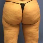 Liposuction Before & After Patient #2251