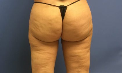 Liposuction Before & After Patient #2251