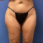 Liposuction Before & After Patient #2251