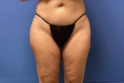 Liposuction Before & After Patient #2251