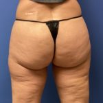 Liposuction Before & After Patient #2251