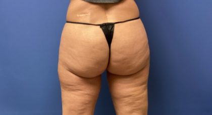 Liposuction Before & After Patient #2251