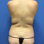 Liposuction Before & After Patient #2256