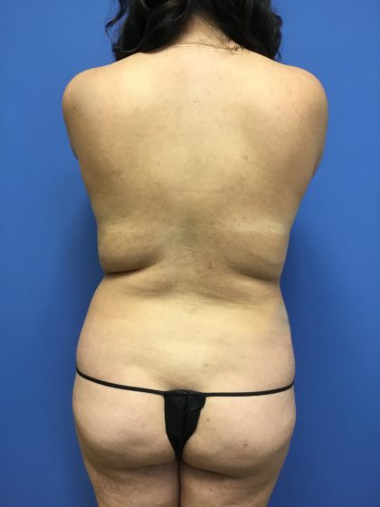 Liposuction Before & After Patient #2256