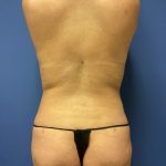 Liposuction Before & After Patient #2256