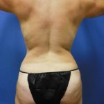 Liposuction Before & After Patient #2259