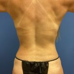 Liposuction Before & After Patient #2259