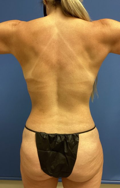 Liposuction Before & After Patient #2259