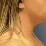 Liposuction Before & After Patient #2262