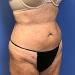 Liposuction Before & After Patient #2265