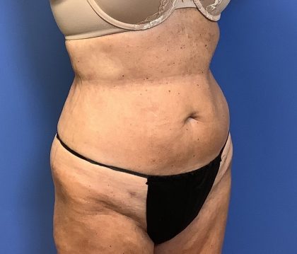 Liposuction Before & After Patient #2265