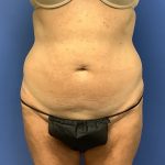 Liposuction Before & After Patient #2265
