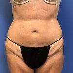 Liposuction Before & After Patient #2265