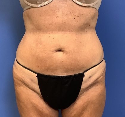 Liposuction Before & After Patient #2265