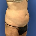 Liposuction Before & After Patient #2265