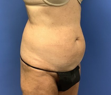 Liposuction Before & After Patient #2265