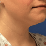 Liposuction Before & After Patient #2270