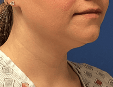 Liposuction Before & After Patient #2270