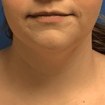 Liposuction Before & After Patient #2270