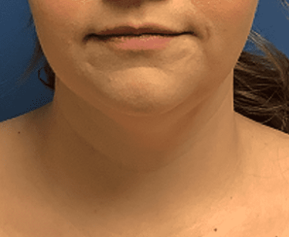 Liposuction Before & After Patient #2270