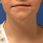 Liposuction Before & After Patient #2270