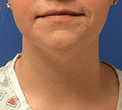 Liposuction Before & After Patient #2270