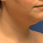 Liposuction Before & After Patient #2270