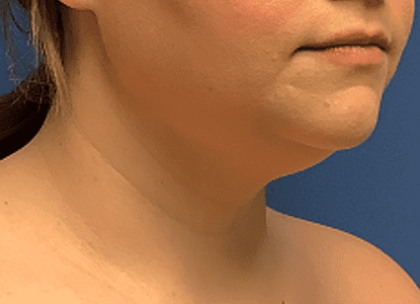 Liposuction Before & After Patient #2270