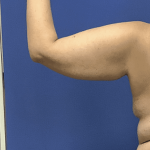 Liposuction Before & After Patient #2275
