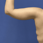 Liposuction Before & After Patient #2275