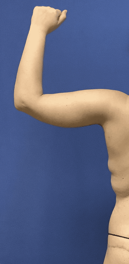 Liposuction Before & After Patient #2275