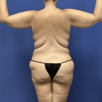 Liposuction Before & After Patient #2278