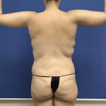 Liposuction Before & After Patient #2278