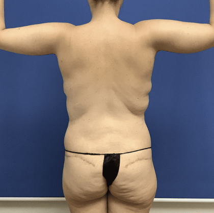 Liposuction Before & After Patient #2278
