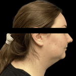 Liposuction Before & After Patient #2304