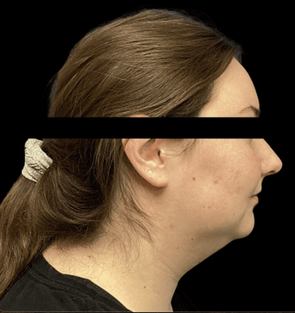 Liposuction Before & After Patient #2304