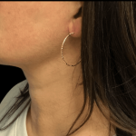 Liposuction Before & After Patient #2309