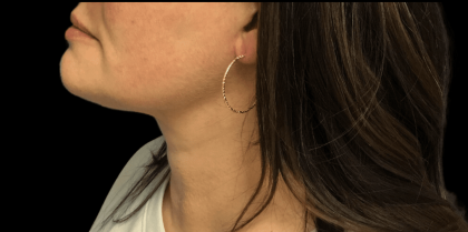 Liposuction Before & After Patient #2309