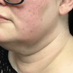 Liposuction Before & After Patient #2309