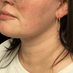 Liposuction Before & After Patient #2309