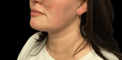 Liposuction Before & After Patient #2309