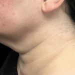 Liposuction Before & After Patient #2309