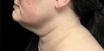 Liposuction Before & After Patient #2309