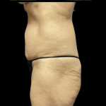 Mommy Makeover Before & After Patient #718
