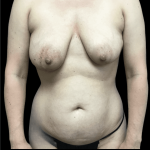 Mommy Makeover Before & After Patient #723