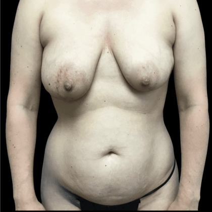 Mommy Makeover Before & After Patient #723