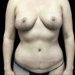 Mommy Makeover Before & After Patient #723