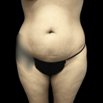 Mommy Makeover Before & After Patient #723
