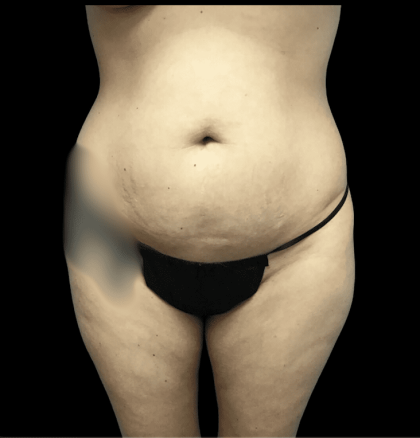 Mommy Makeover Before & After Patient #723