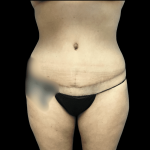 Mommy Makeover Before & After Patient #723